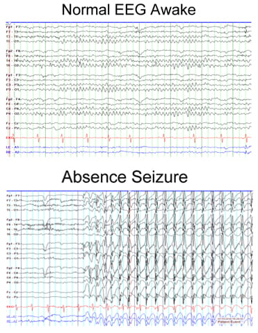 Juvenile Absence Epilepsy (JAE)| Children's Hospital Pittsburgh