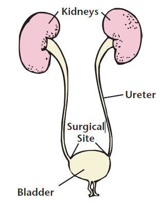 Ureteral Reimplantation Surgery Children S Hospital Pittsburgh